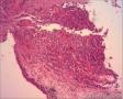 女57 鼻腔新生物+图看核仁图19