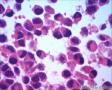 女57 鼻腔新生物+图看核仁图26