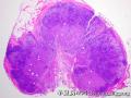 Lymph node, inguinal图2