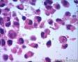女57 鼻腔新生物+图看核仁图30