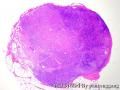 Lymph node, inguinal图1