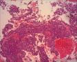 女57 鼻腔新生物+图看核仁图16