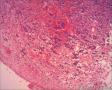 女57 鼻腔新生物+图看核仁图8