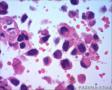 女57 鼻腔新生物+图看核仁图29