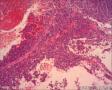 女57 鼻腔新生物+图看核仁图17