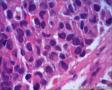 女57 鼻腔新生物+图看核仁图28