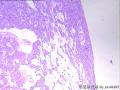 女 67  右腮腺肿块10月余图6