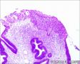 24765, 宫颈活检，有细胞学图33