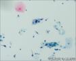 24765, 宫颈活检，有细胞学图17