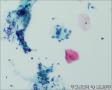 24765, 宫颈活检，有细胞学图21