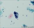 24765, 宫颈活检，有细胞学图19