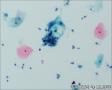 24765, 宫颈活检，有细胞学图1