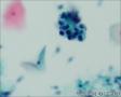 24765, 宫颈活检，有细胞学图27