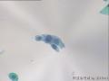 宫颈TCT图13