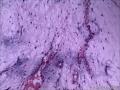 右侧腘窝肿物，关节旁黏液瘤？图9