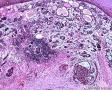 食管肿瘤附IHC,基底细胞鳞癌或腺样囊性癌，如何解读IHC?求教分析图1