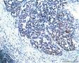 食管肿瘤附IHC,基底细胞鳞癌或腺样囊性癌，如何解读IHC?求教分析图12