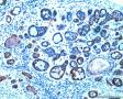 食管肿瘤附IHC,基底细胞鳞癌或腺样囊性癌，如何解读IHC?求教分析图17