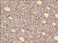 求助：小孩，臀部包块图14