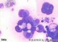 解释一下：“国外病例，稍后公布答案：Ascites cytology, 34-year old female，positive for adenocarcinoma图4
