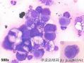 解释一下：“国外病例，稍后公布答案：Ascites cytology, 34-year old female，positive for adenocarcinoma图3