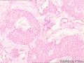 请教左手第四指肿物，怎么诊断？图22