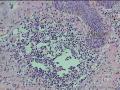 右面颊部皮肤肿物图1