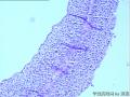 请看膀胱乳头状肿瘤报什么，固有膜内组织是内翻还是有浸润？图12