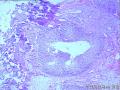 请看膀胱乳头状肿瘤报什么，固有膜内组织是内翻还是有浸润？图1
