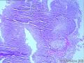 请看膀胱乳头状肿瘤报什么，固有膜内组织是内翻还是有浸润？图6
