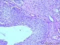 请看膀胱乳头状肿瘤报什么，固有膜内组织是内翻还是有浸润？图14