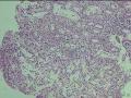 胃溃疡图4