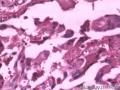 甲状腺乳头状癌二次手术标本图18