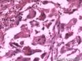 甲状腺乳头状癌二次手术标本图17