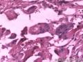 甲状腺乳头状癌二次手术标本图19