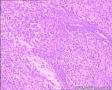 左中指末节肿物图9