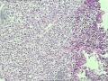 83岁肺占位穿刺图2