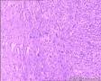 左中指末节肿物图7
