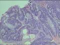 右眼内眦泪阜处肿物图3