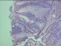 右眼内眦泪阜处肿物图7