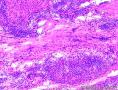 报了倾向良性的了，待石蜡看有无脉管瘤栓和包膜浸润，大家看看呢？石蜡出来了，复杂啊，大家看看。图30