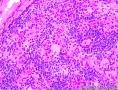 报了倾向良性的了，待石蜡看有无脉管瘤栓和包膜浸润，大家看看呢？石蜡出来了，复杂啊，大家看看。图34