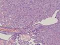 左睾丸鞘膜结节图14