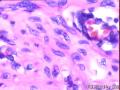 腹膜后肿物图12