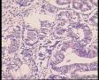 子宫切除内膜病变图9