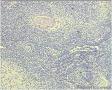 左面部肿物图10