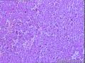 右肾上腺肿物，嗜铬细胞瘤？图6