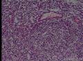 恶性淋巴瘤？类型图13
