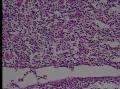 恶性淋巴瘤？类型图10