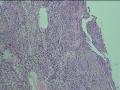 左上臂肌肉内肿物图3